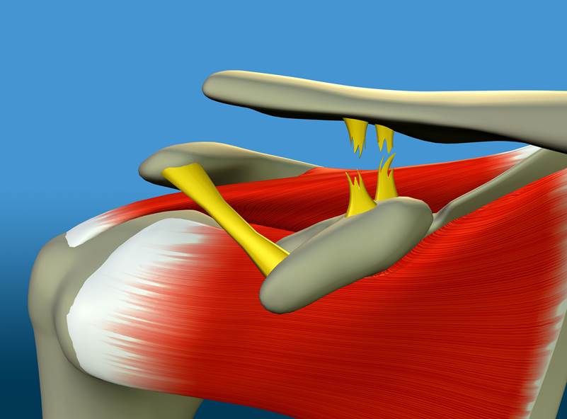 ACL Reconstruction surgery